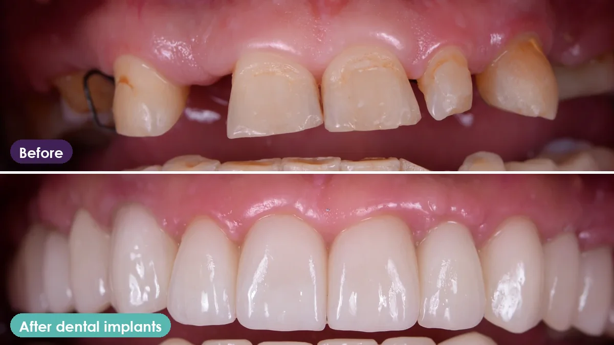 Worn and missing teeth before treatment, and the restored smile after dental implants
