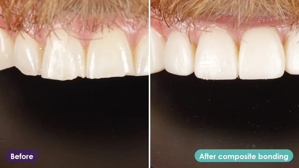 Front teeth before and after composite bonding at William Place Dental Aesthetics in Bow