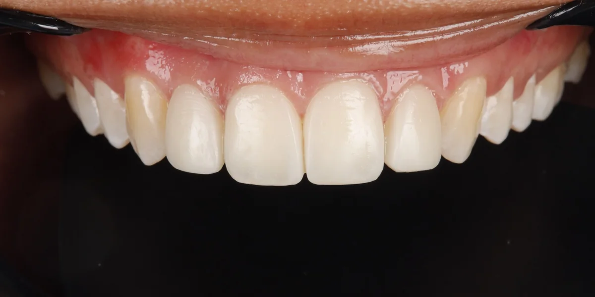The same teeth after composite bonding, gaps closed and the front teeth reshaped
