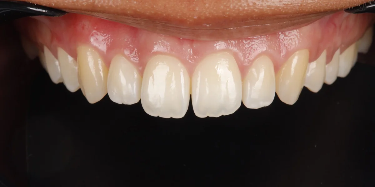 Teeth before composite bonding, gaps closed and the front teeth reshaped