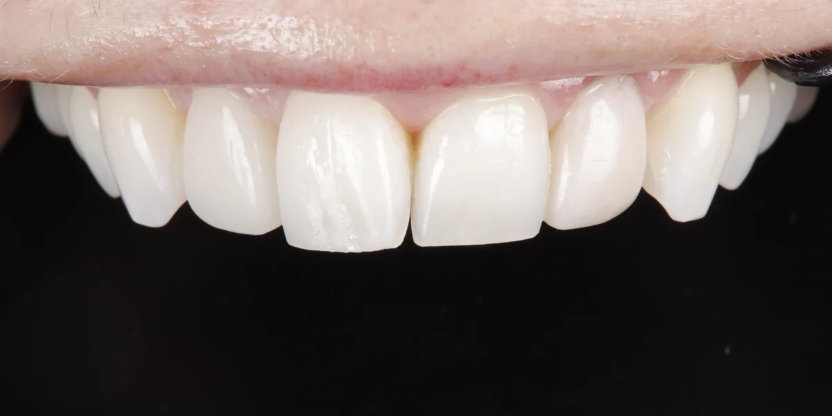 The same teeth after composite bonding, a discoloured tooth masked and the edges evened up
