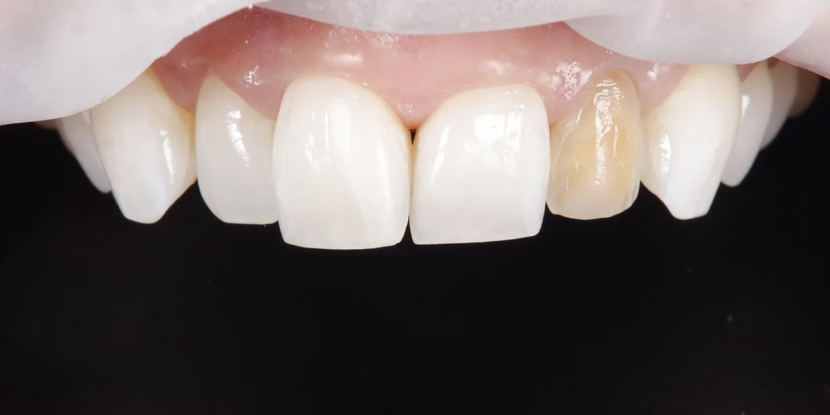 Teeth before composite bonding, a discoloured tooth masked and the edges evened up