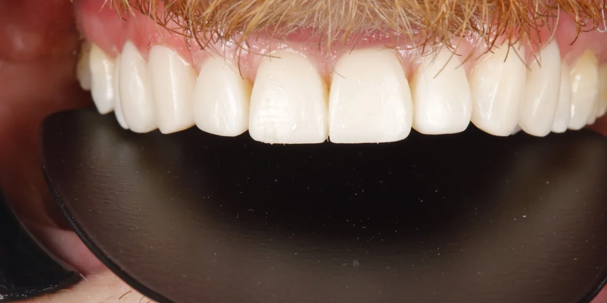 The same teeth after composite bonding, eight worn and chipped front teeth rebuilt with composite veneers in one visit