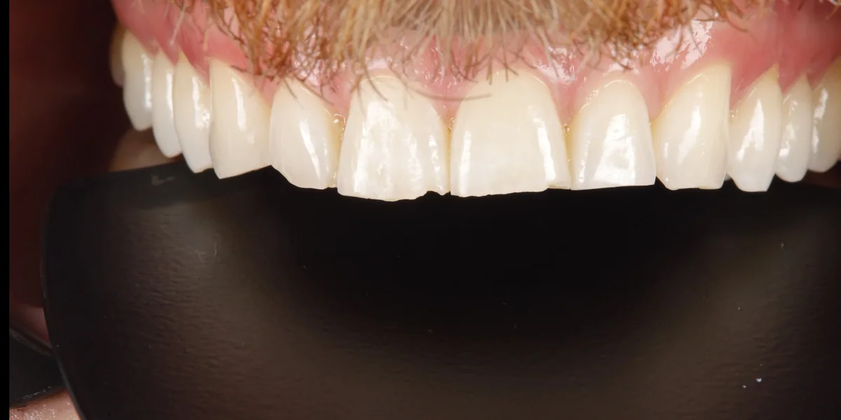 Teeth before composite bonding, eight worn and chipped front teeth rebuilt with composite veneers in one visit