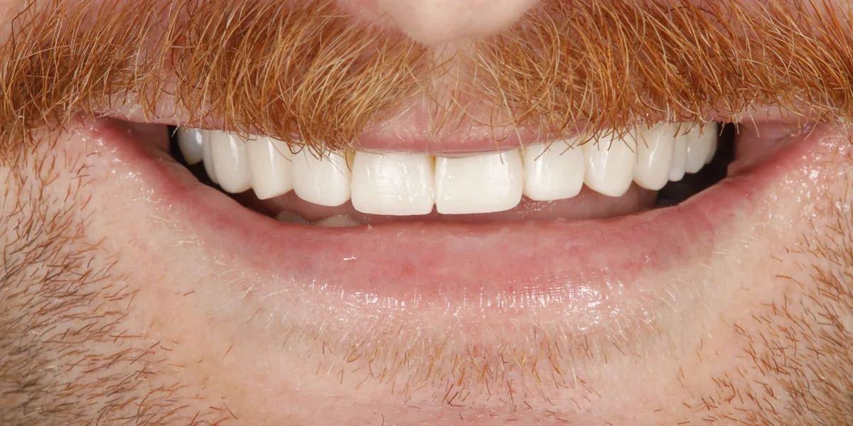 The same teeth after composite bonding, the same patient's smile, after whitening and composite veneers