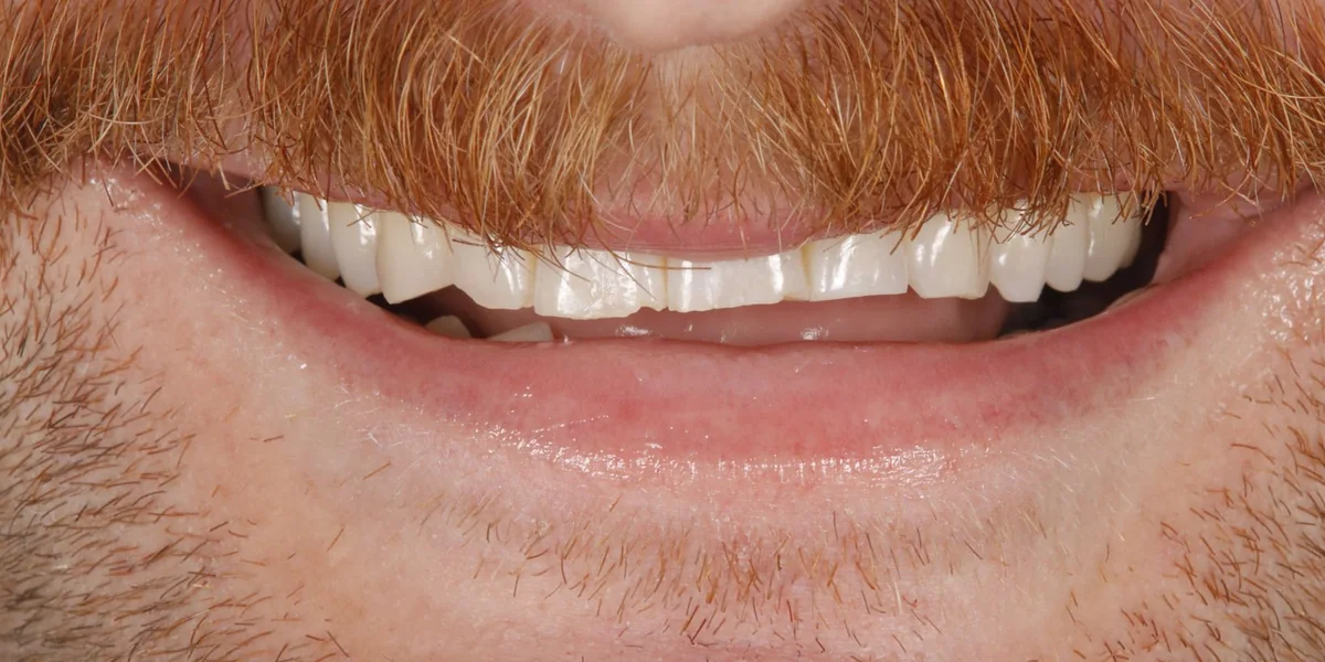 Teeth before composite bonding, the same patient's smile, after whitening and composite veneers