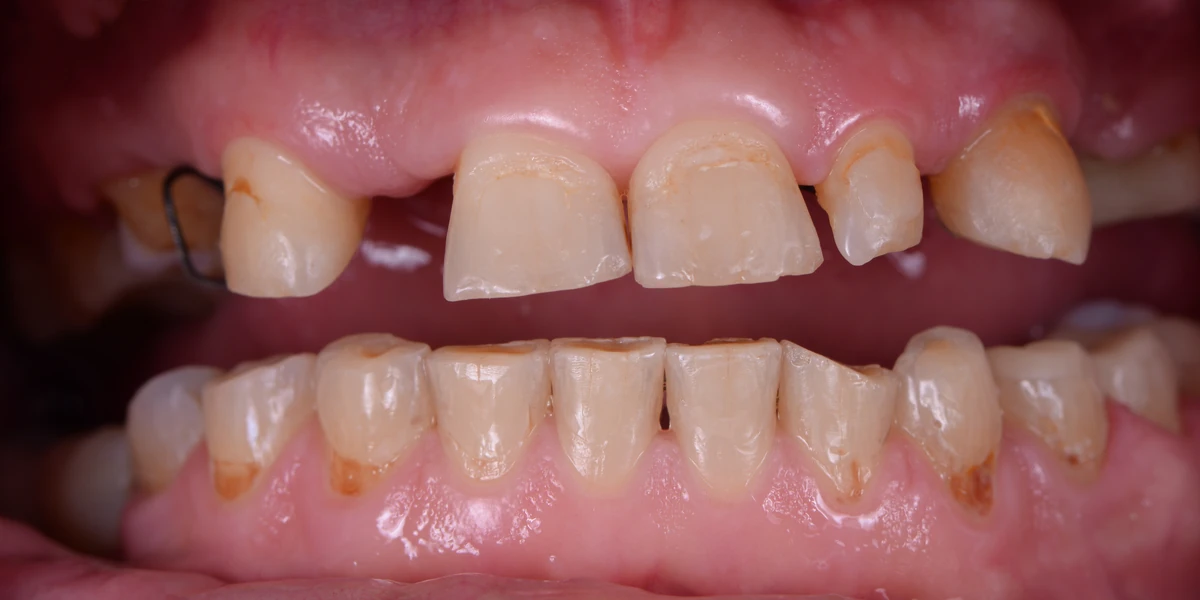 Teeth before implant treatment, a full upper and lower reconstruction