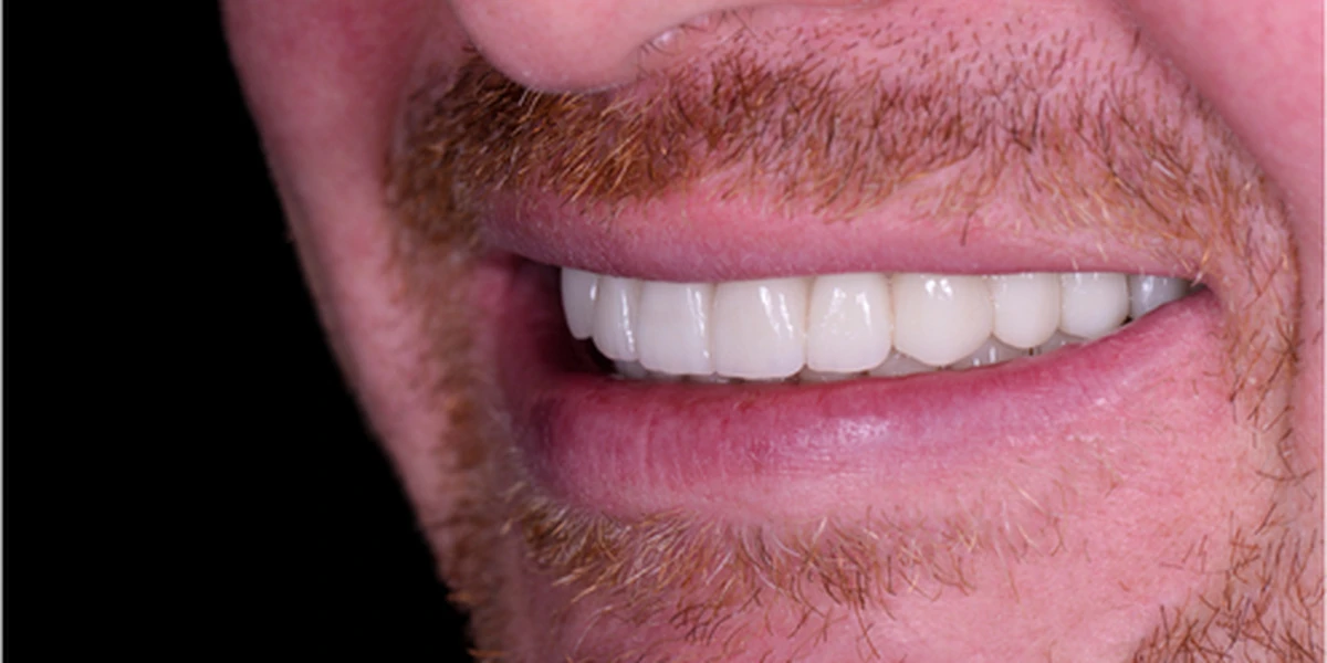 The same teeth after implant treatment, worn and missing teeth restored