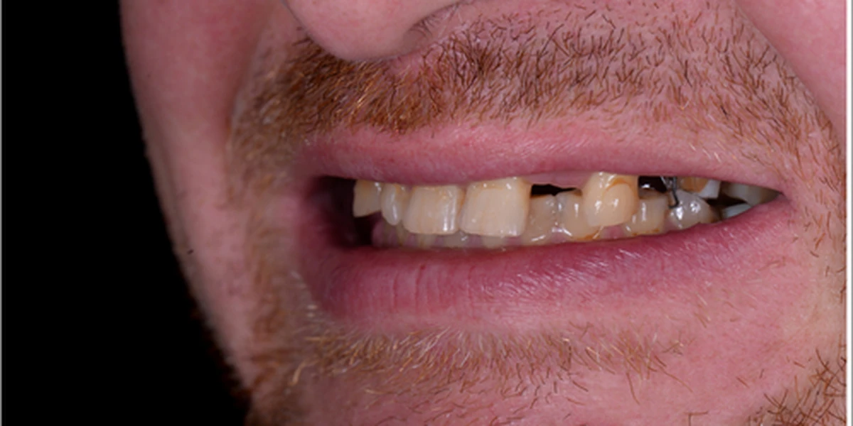 Teeth before implant treatment, worn and missing teeth restored