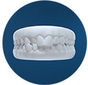 Dental model showing crossbite