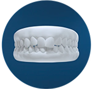 Dental model showing crowding