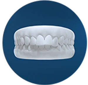Dental model showing overjet