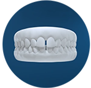 Dental model showing spacing