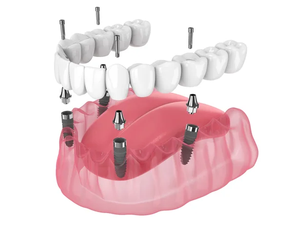 Model of a full fixed bridge screwed onto dental implants