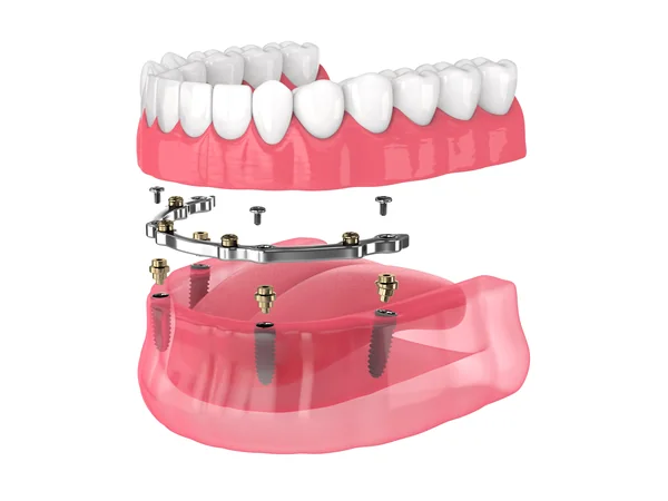 Model of a removable denture anchored onto a bar fixed to implants