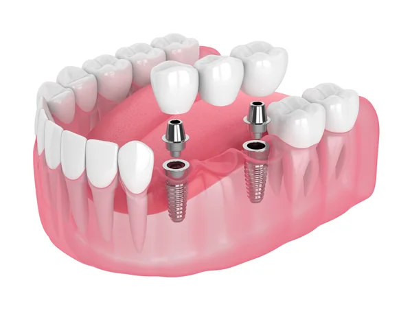 Model of two dental implants supporting several crowns