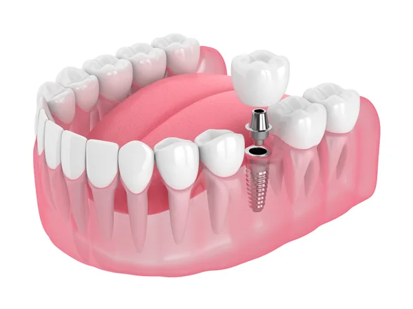 Model of a single dental implant supporting one crown