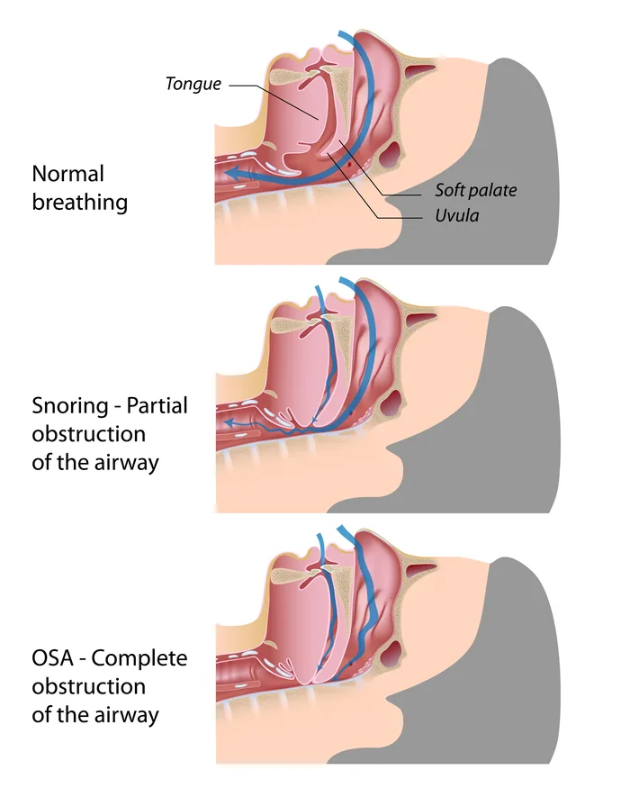 Diagram comparing normal breathing, partial airway obstruction in snoring, and complete obstruction in obstructive sleep apnoea