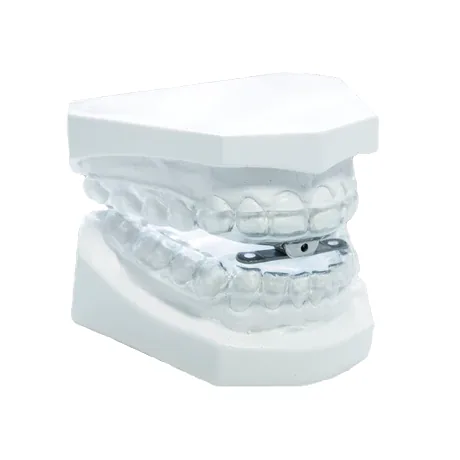 A Sleepwell mandibular advancement splint fitted to a dental model
