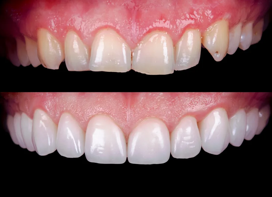 A smile photographed before and after treatment with porcelain veneers