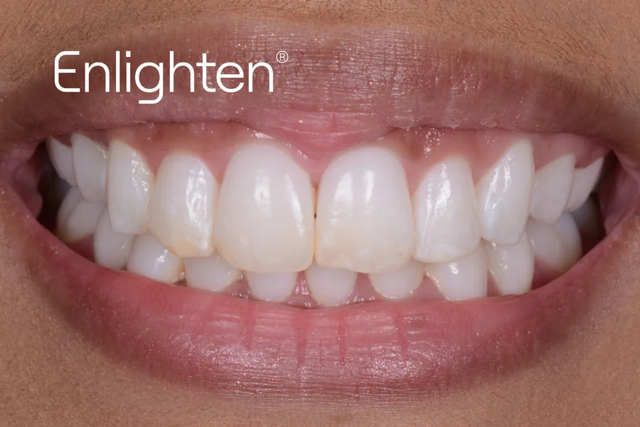 The same teeth after Enlighten whitening, case 1