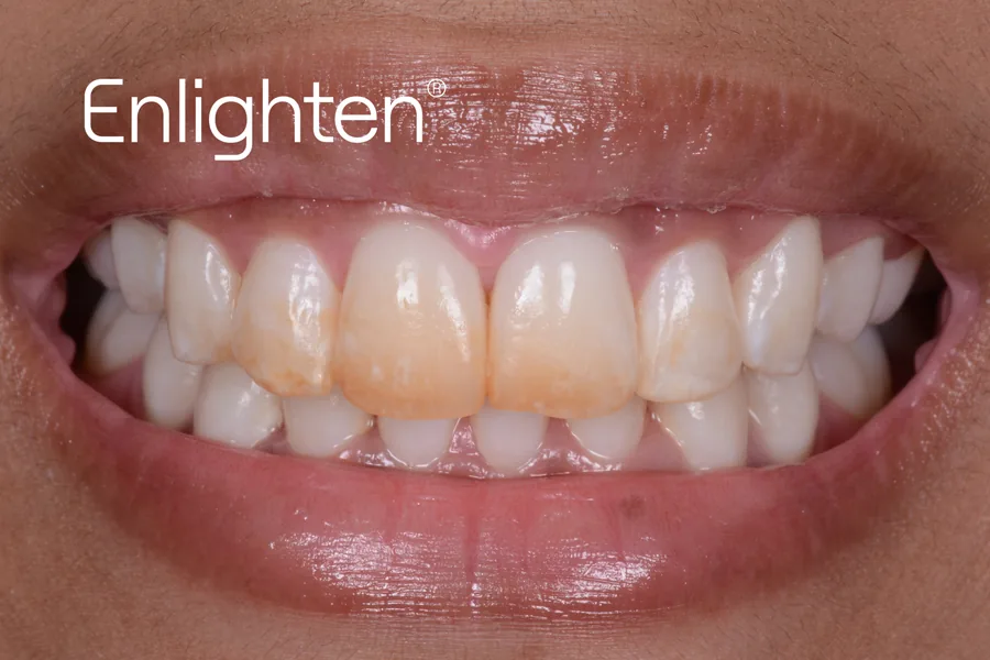 Teeth before Enlighten whitening, case 1