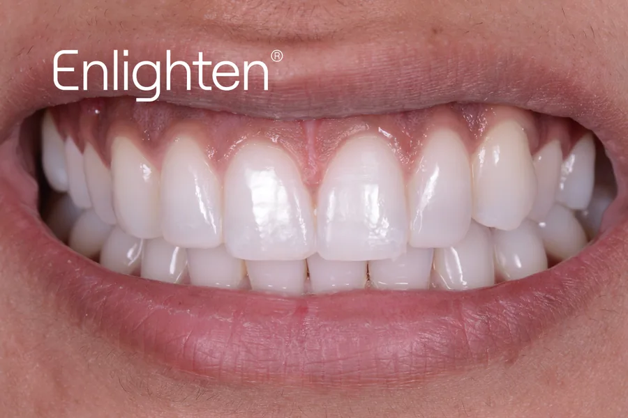 The same teeth after Enlighten whitening, case 2