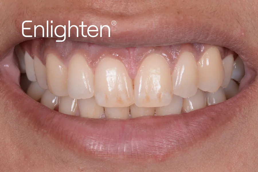 Teeth before Enlighten whitening, case 2