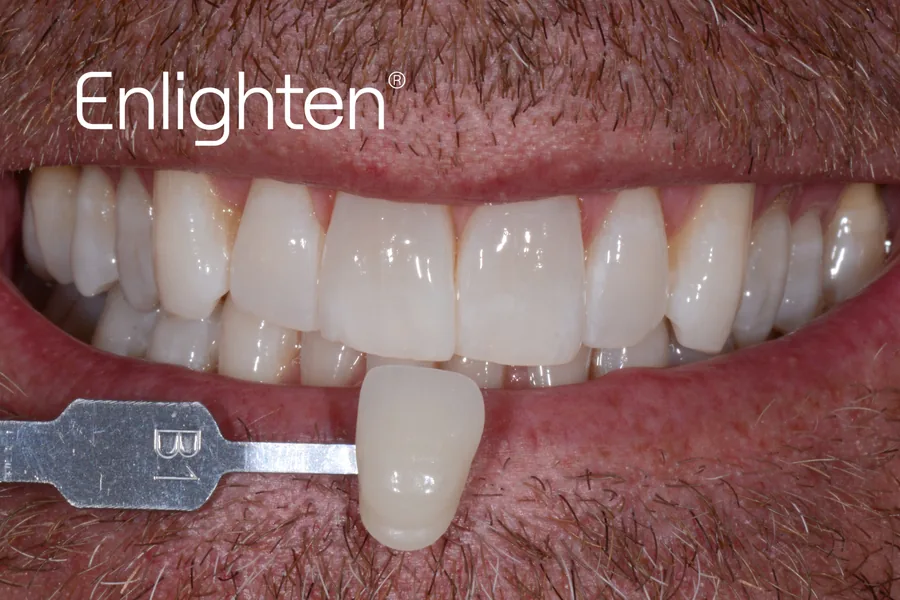 The same teeth after Enlighten whitening, case 3