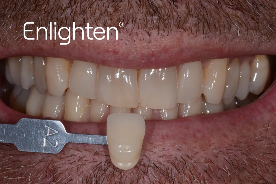 Teeth before Enlighten whitening, case 3