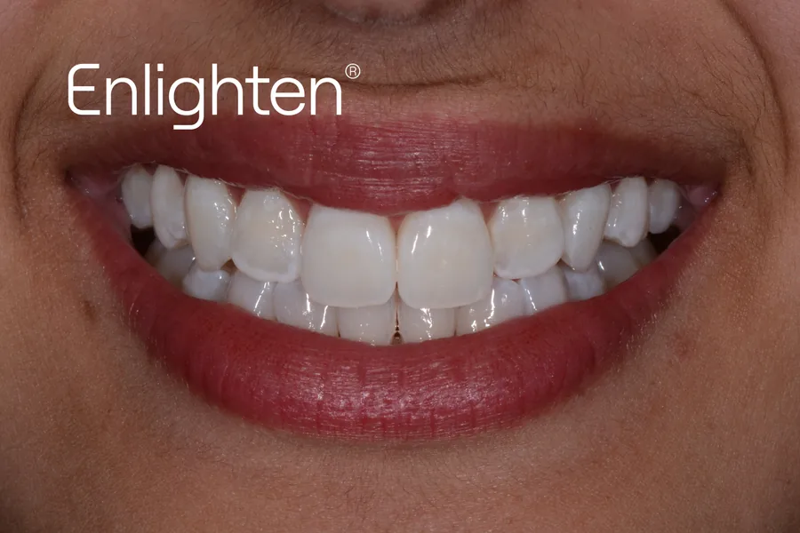 The same teeth after Enlighten whitening, case 4