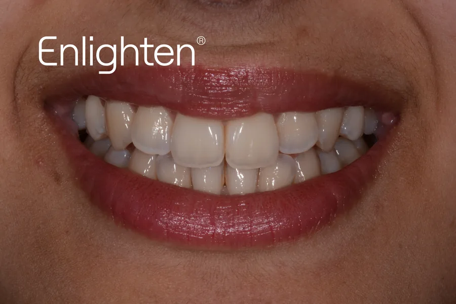 Teeth before Enlighten whitening, case 4