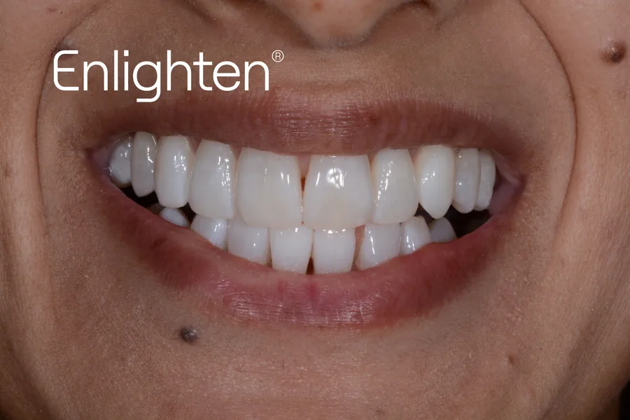 The same teeth after Enlighten whitening, case 6