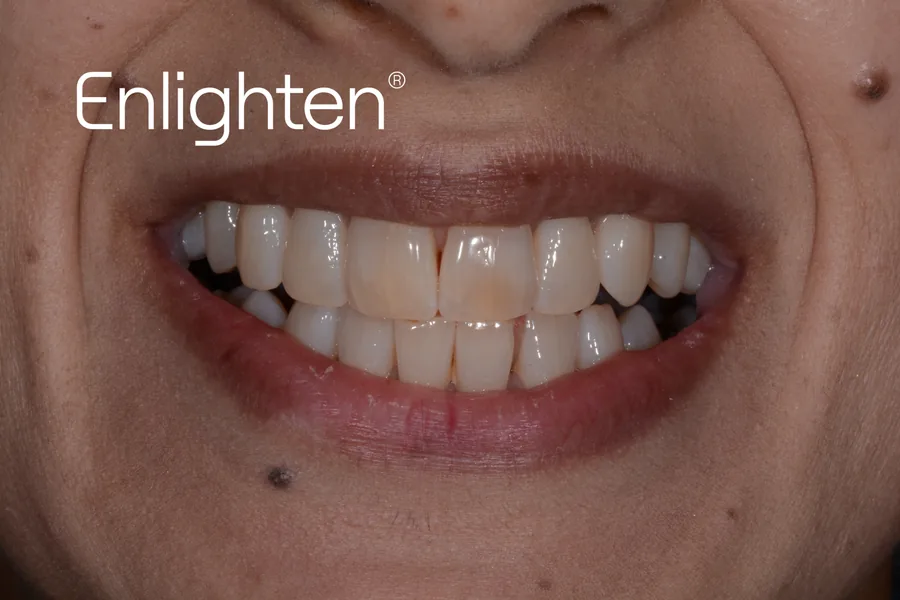 Teeth before Enlighten whitening, case 6
