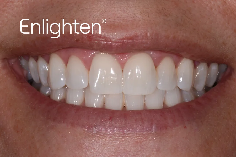 The same teeth after Enlighten whitening, case 7