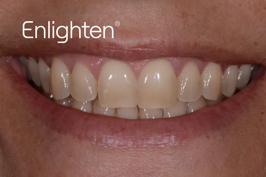 Teeth before Enlighten whitening, case 7